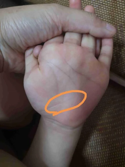 健康线又叫什么线_2