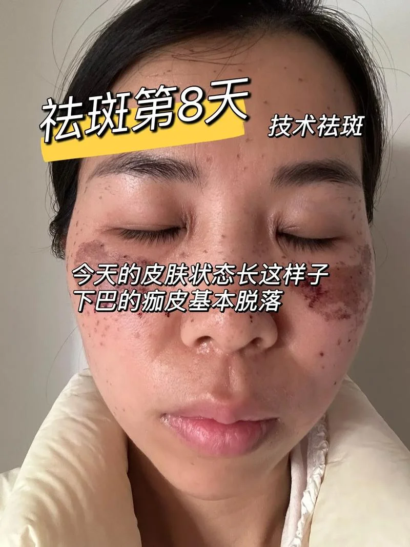 用祛斑霜脸上脱皮怎么回事_2