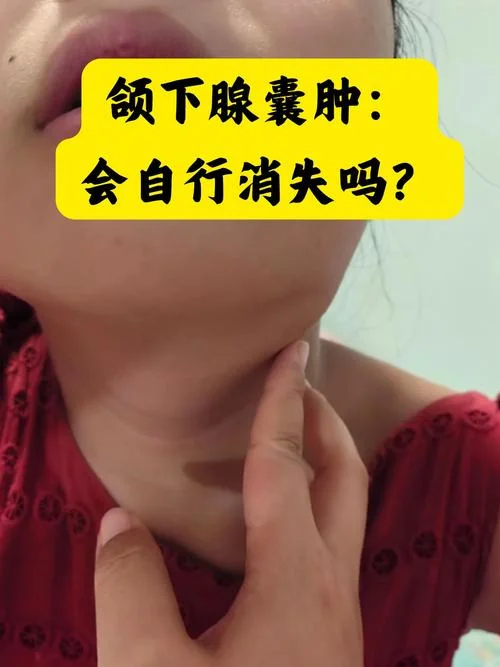 什么是腺体肿大_1