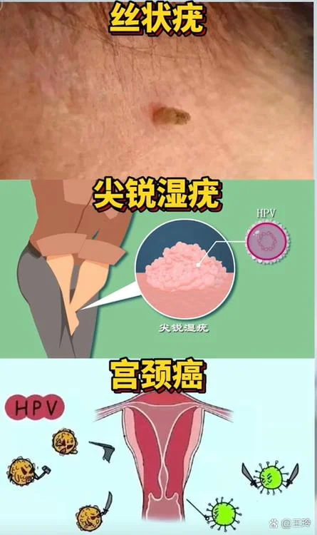 什么是hvp感染宫颈癌_1