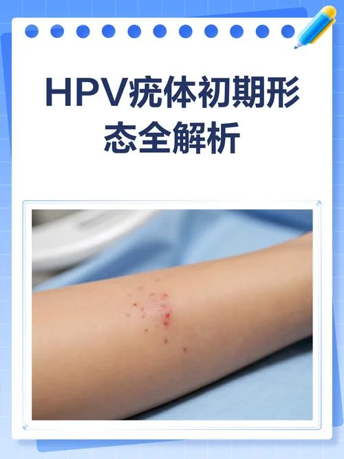 什么是hpv病毒感染图片_1