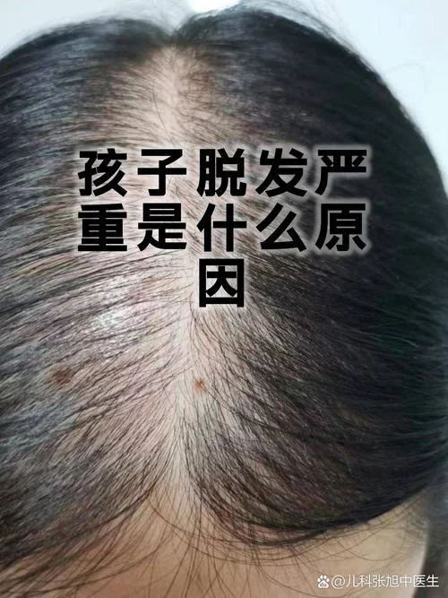 梦到掉发严重秃一块是什么梦-掉发秃块梦