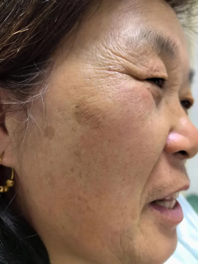 老年斑成什么样是恶性_1