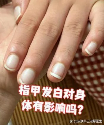 指甲发白是有什么病吗_1