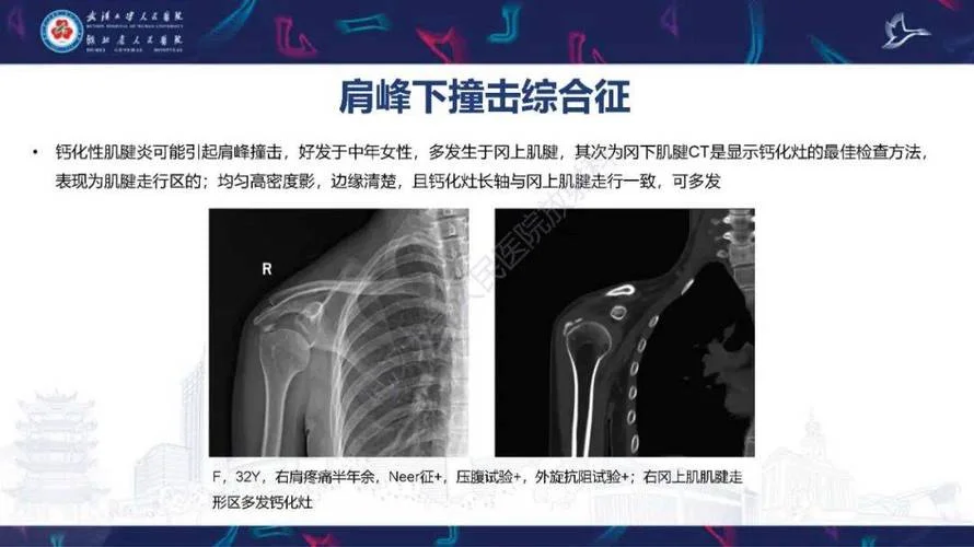 什么是肩峰撞击综合征_2