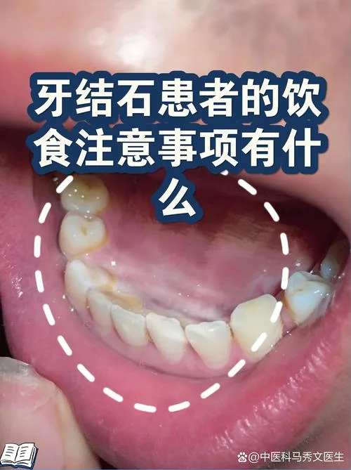 梦见牙结石掉了怎么办_2