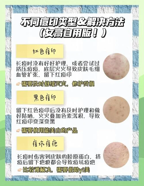 满脸痘印和斑怎么办-祛痘印斑印全解