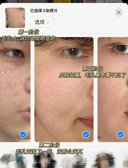 最近毛孔粗大长痘痘怎么办-毛孔大长痘怎么办