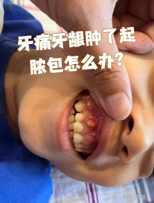 做梦梦到牙龈肿了-梦到牙龈肿痛