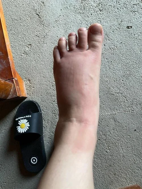 梦见被蚂蚁咬脚指_2