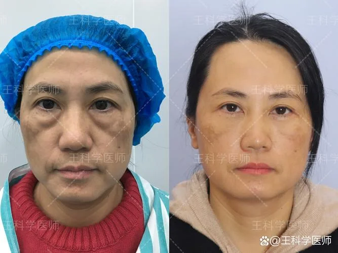 眼袋抽脂手术怎么做-眼袋手术抽脂怎么做