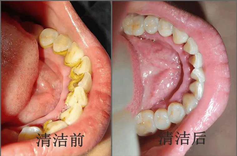史上最厚牙结石_2