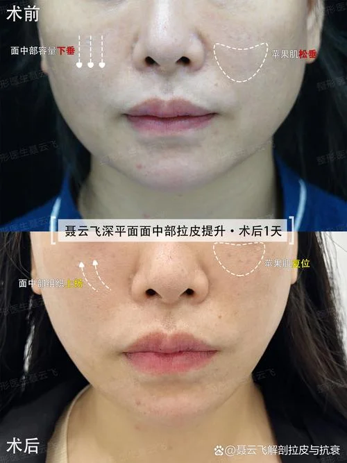 没有苹果肌怎么办_2