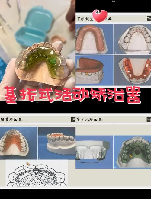什么是正畸治疗_1