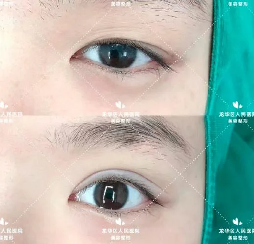 学开双眼皮微整哪里有-学开双眼皮微整找哪里