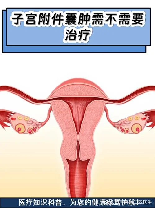 如何查附件囊肿-查询附件囊肿方法