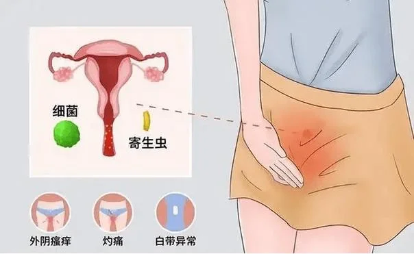 分泌物清洁度二度是什么意思_2