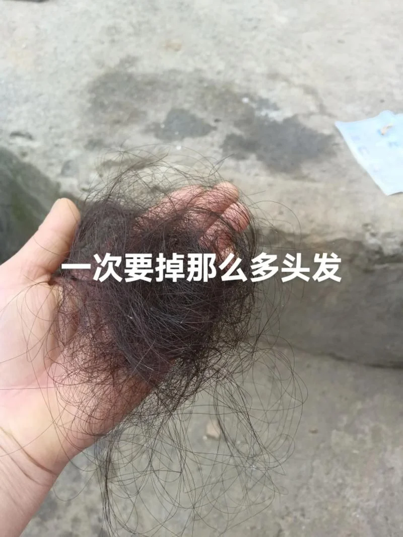 年龄大掉头发怎么办-大龄掉发如何应对