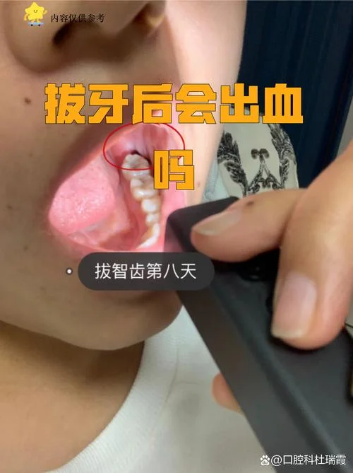 梦到牙齿掉了并且有血-梦掉牙出血