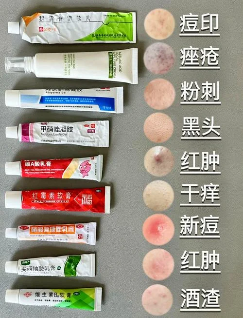 祛痘的产品哪个品牌好-祛痘产品品牌推荐