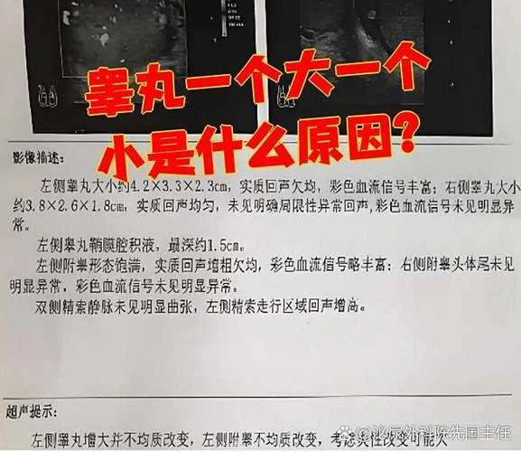 什么是附睾炎新生儿_1