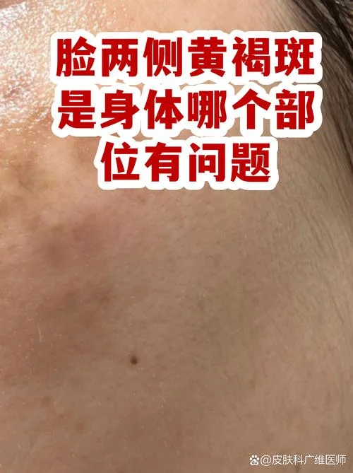脸颊长斑叫什么斑_1