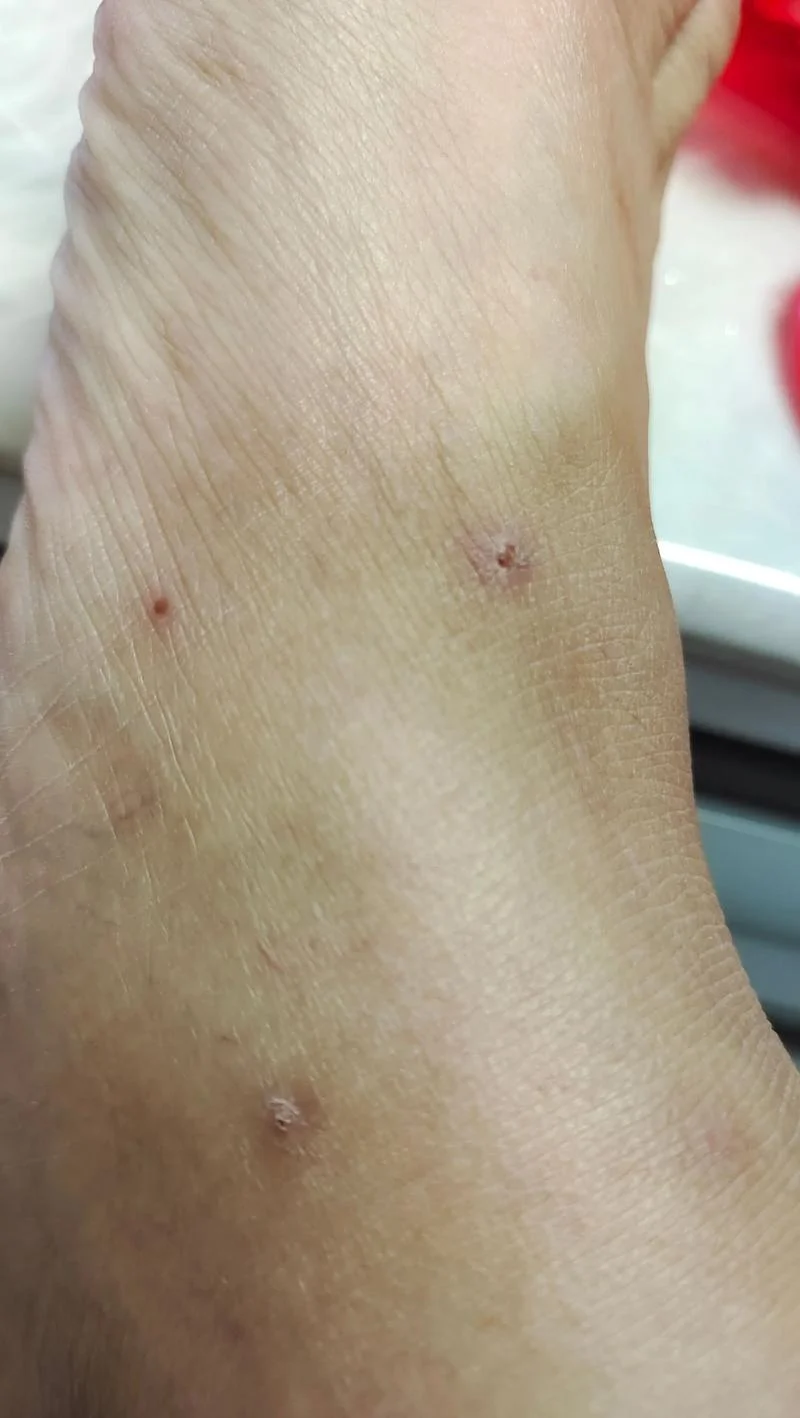 被蚂蚁咬了很痒怎么办-蚂蚁咬痒如何缓解