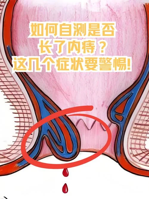 如何查出自己有痔疮_1