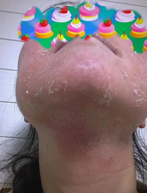 梦见脸脱皮一搓特干净_1