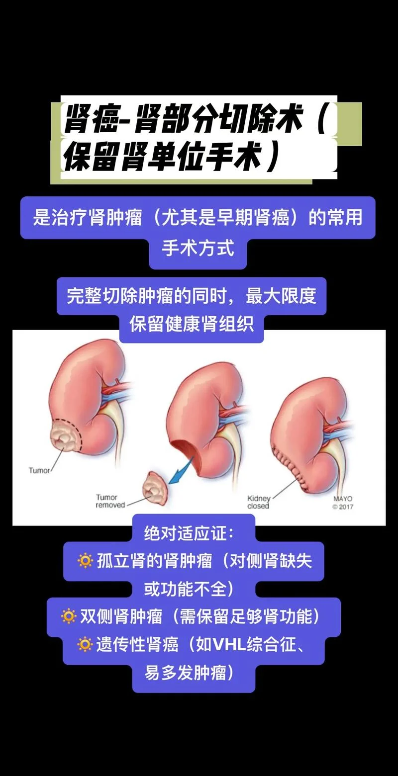 什么是左肾癌_1