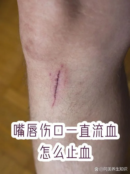 梦到受伤流血掉肉_2