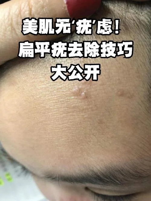 眼皮上长扁平疣怎么办-眼皮扁平疣如何治疗