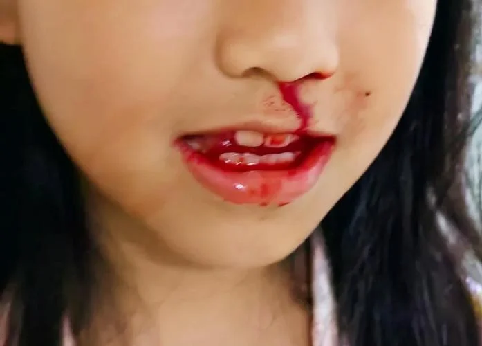 女人做梦自己鼻子流血-女人梦见自己鼻子流血