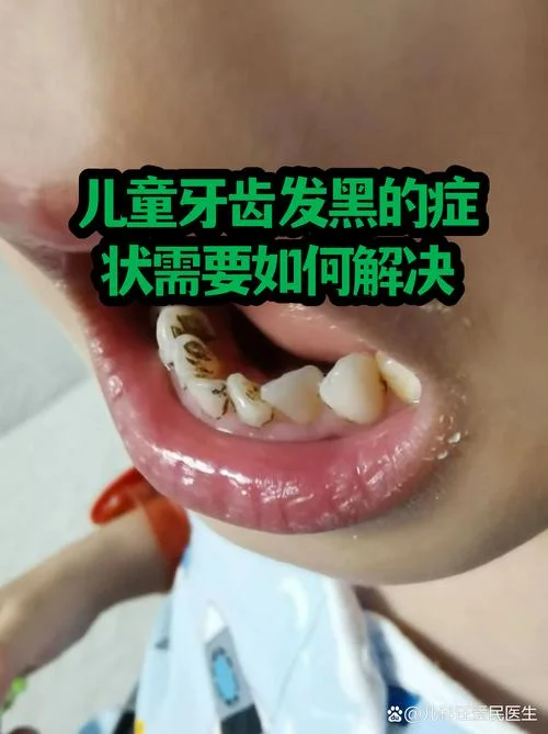 牙齿底下发黑是为什么_2