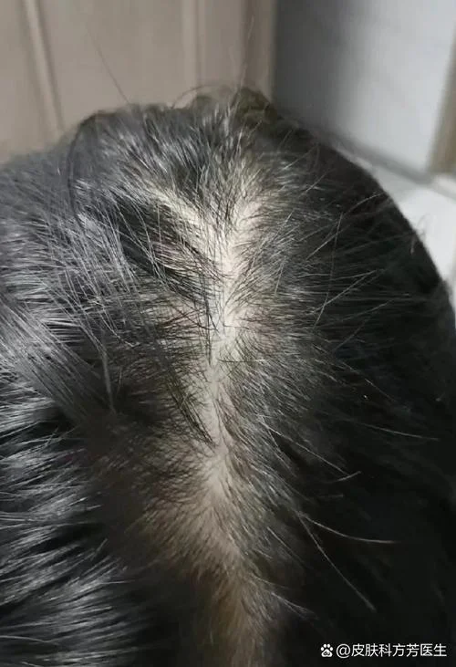 女人梦见掉头发死老公_2