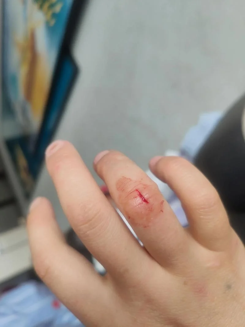 女人梦到手掌割破流血_1