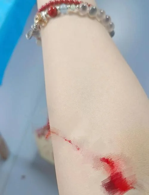 孕妇梦见自己胳膊流血_2