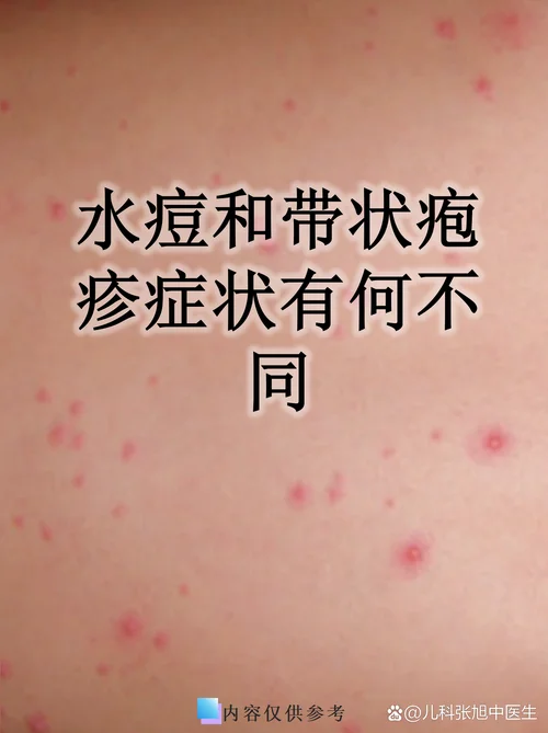 皮肤长水痘过敏了怎么办_1