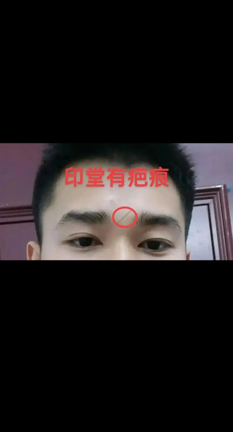 印堂后天长斑面相_1