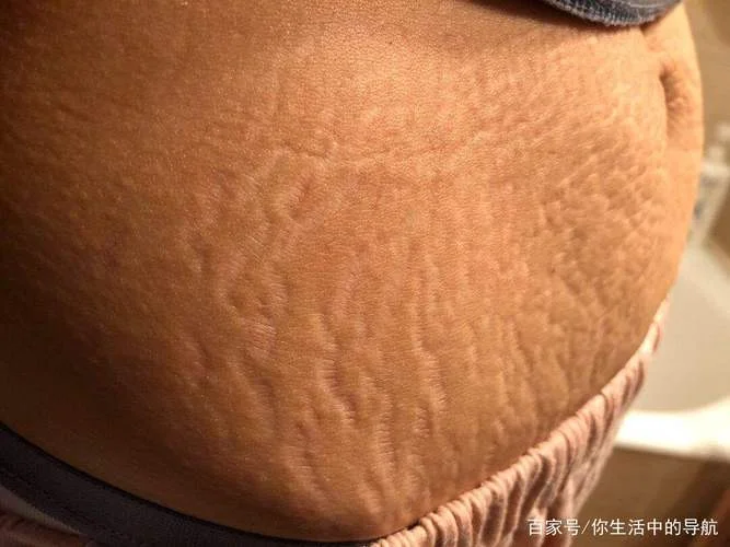 孕妇梦到自己长妊娠纹_2