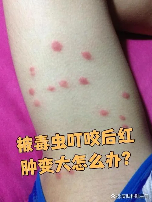 梦见昆虫咬自己-梦被虫咬
