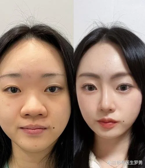 什么是肉鼻子_1