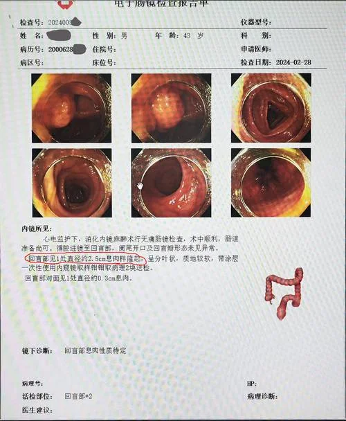 胃镜检查怎么做图片-胃镜检查图示