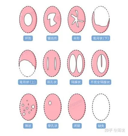 怎么看出处女膜_2