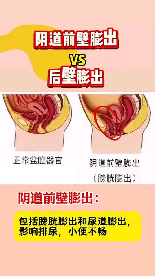 盆腔膨出怎么办_1