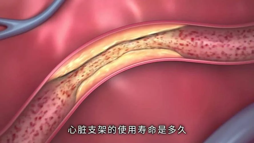 心脏支架全称叫什么-心脏支架全称