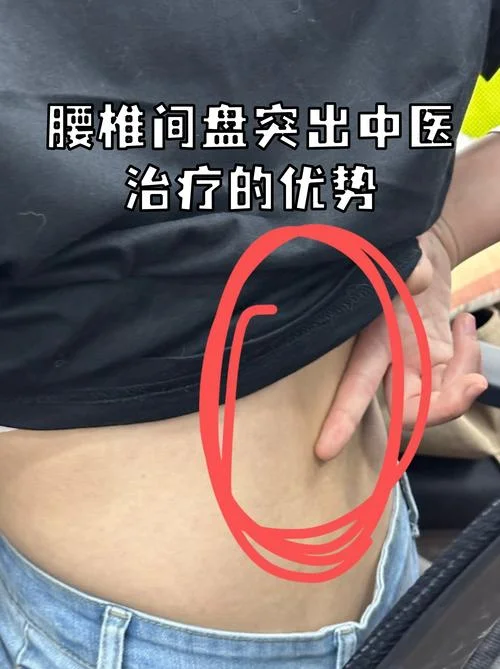 腰间盘突出自测方法-腰椎间盘突出自测法