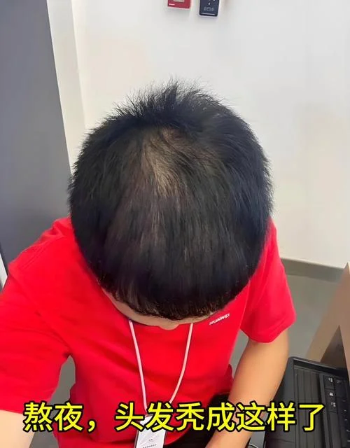 梦到自己秃了-梦见自己掉光了头发