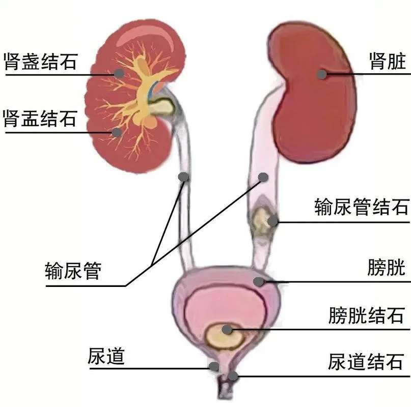 尿道结石中医叫什么_1