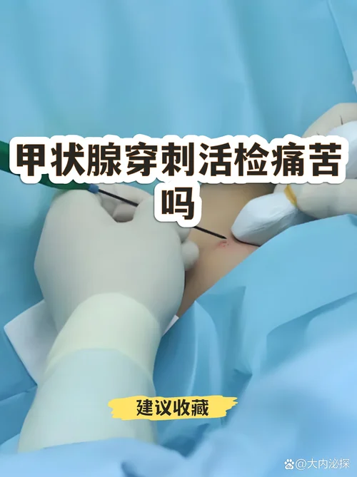 甲状腺穿刺检查叫什么_1